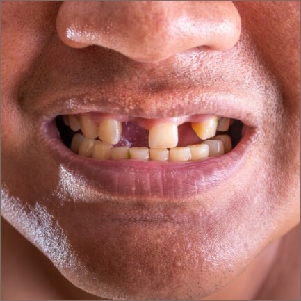 Closeup of smile with multiple missing teeth