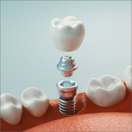 Animated smile during dental implant placement