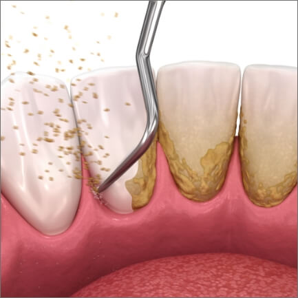 Animated smile during scaling and root planing gum disease treatment