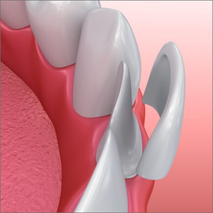 Animated smile during veneers placement by a cosmetic dentist
