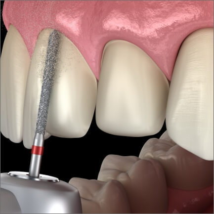 Animated smile during veneers process