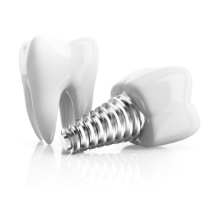 Dental implant and molar