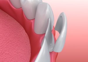 graphic showing veneers over teeth