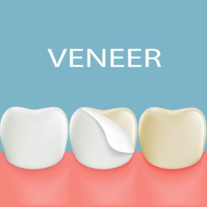 diagram of veneer