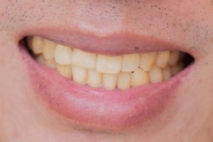 man showing badly stained teeth