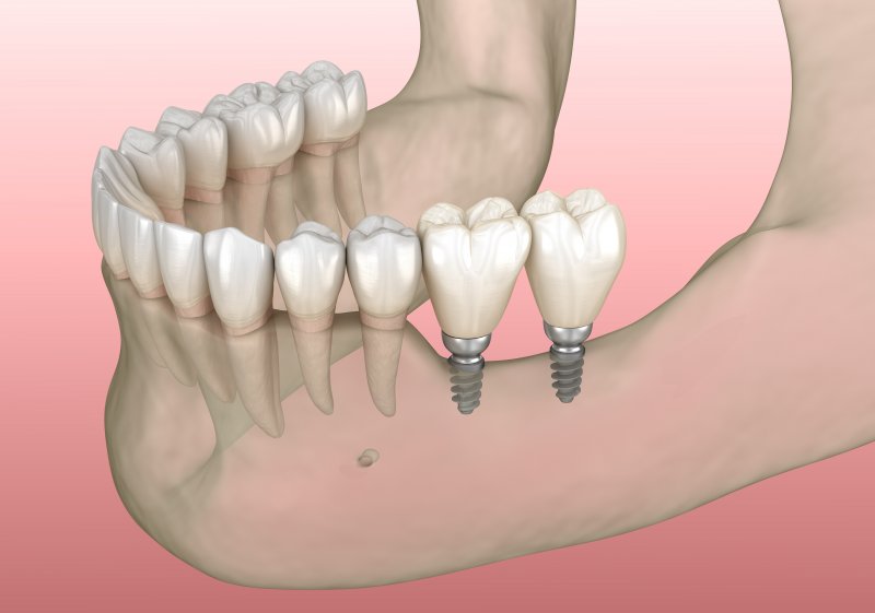 Digital model showing two mini dental implants