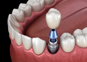 Parts of single dental implant
