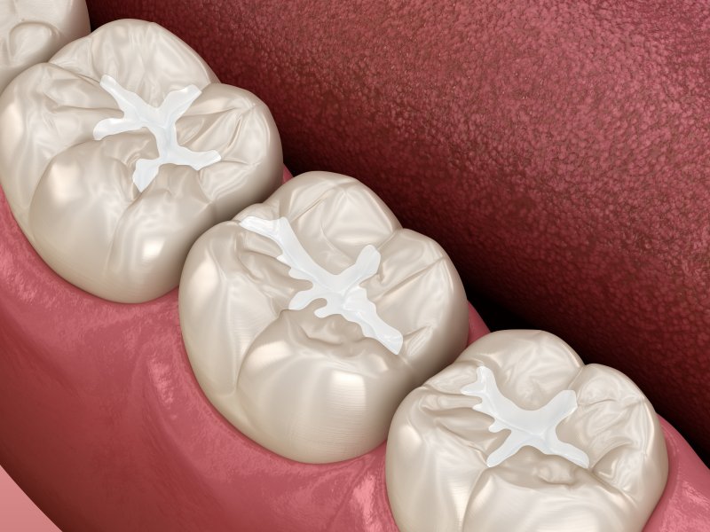 3D rendering of molar fillings