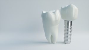 Image of dental implants.