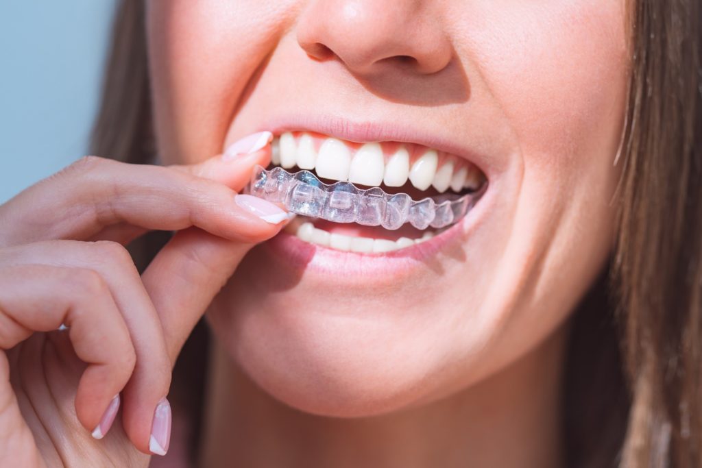 Closeup of woman putting on clear aligners