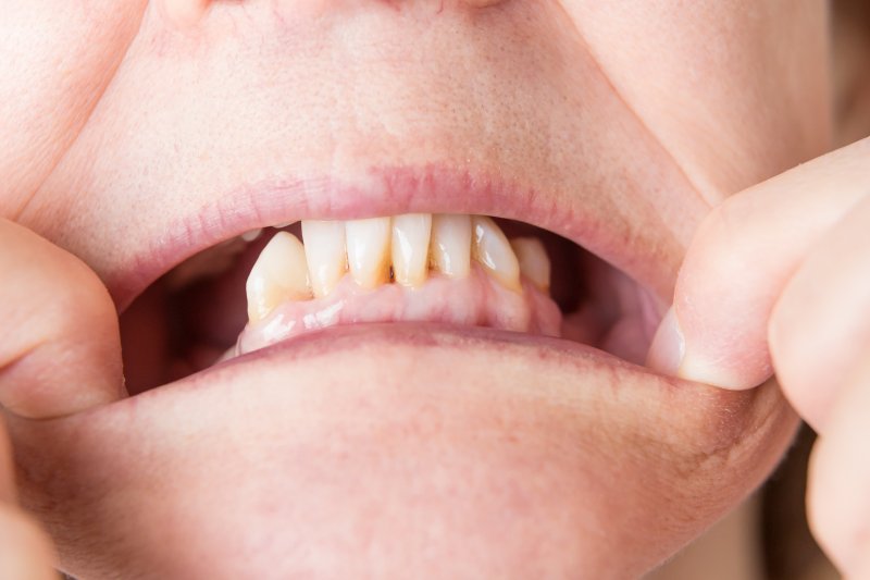 A close-up of a mouth with a missing back tooth