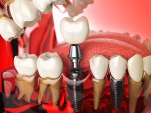 Digital model of a dental implant