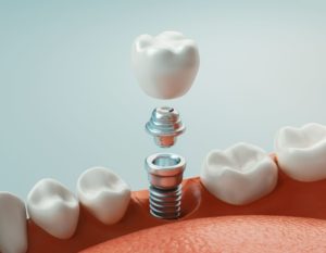 Illustration showing a dental implant's components inserted into a jaw