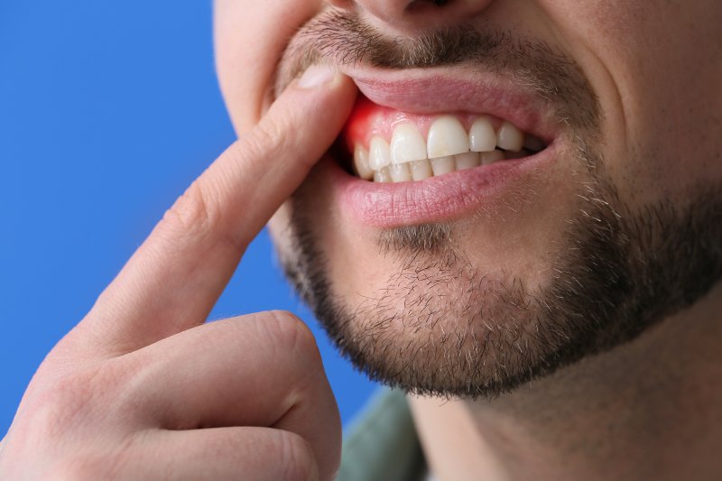 A man revealing his gum disease